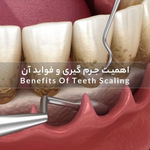 جرم گیری دندان و فواید آن