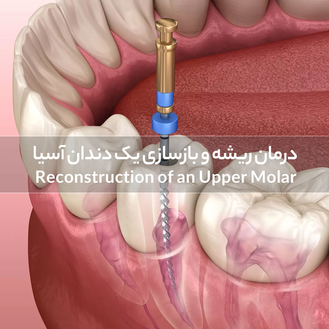 درمان ریشه و بازسازی یک دندان آسیا