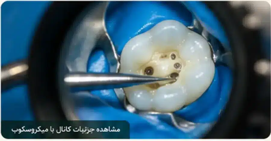 میکروسکوپ دندانپزشکی برای مشاهده جزئیات کانال ریشه در درمان اندودانتیک